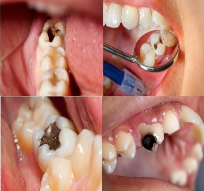 Decay tooth cavities causes lybrate medium