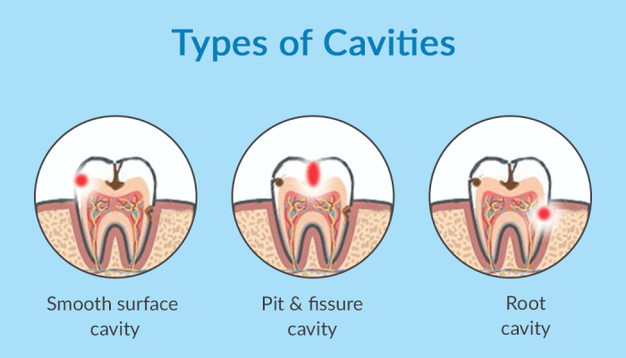 Cavities form dental where